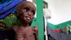 Somalia: Cholera-Ausbruch in Fl&uuml;chtlingslagern