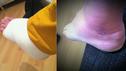Mücken: Kleiner Stich, schlimme Folgen