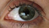 Office-Eye-Syndrom: Was hilft gegen trockene Augen?